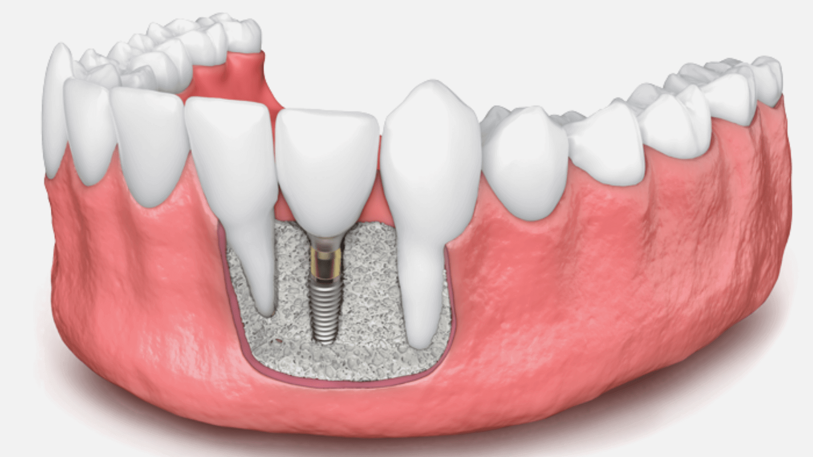 one day full mouth dental implants cost